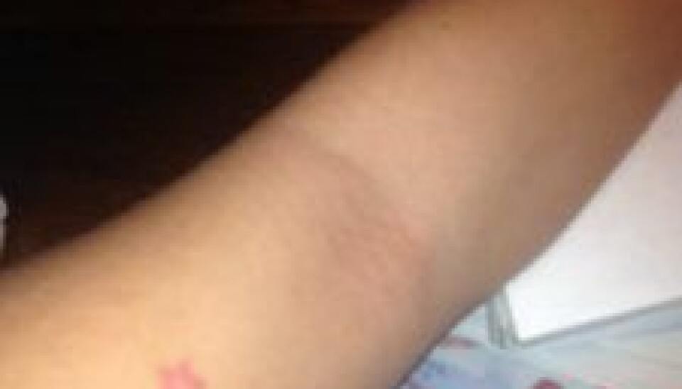 Malene er ikke tilfreds med sin tatovering, som hun fik lavet i en kæmpe brandert. (Foto: Privat)