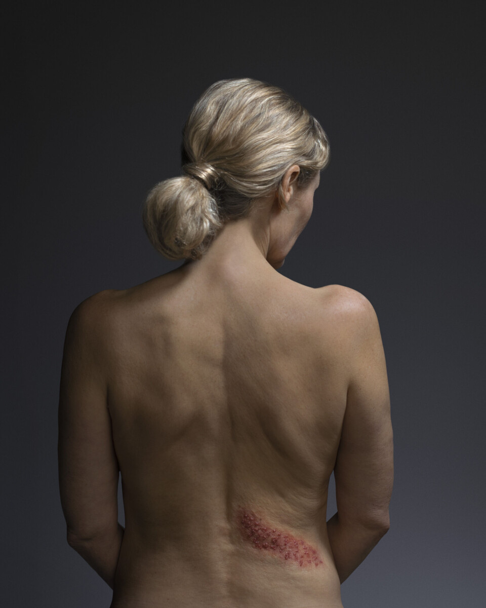 Vidste du dette? Du kan risikere at få denne sygdom, hvis du har haft skoldkopper