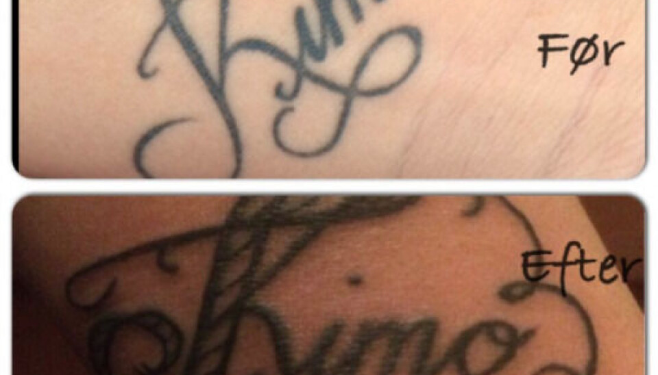 Her ses tatoveringen før og efter (Foto: Privat)