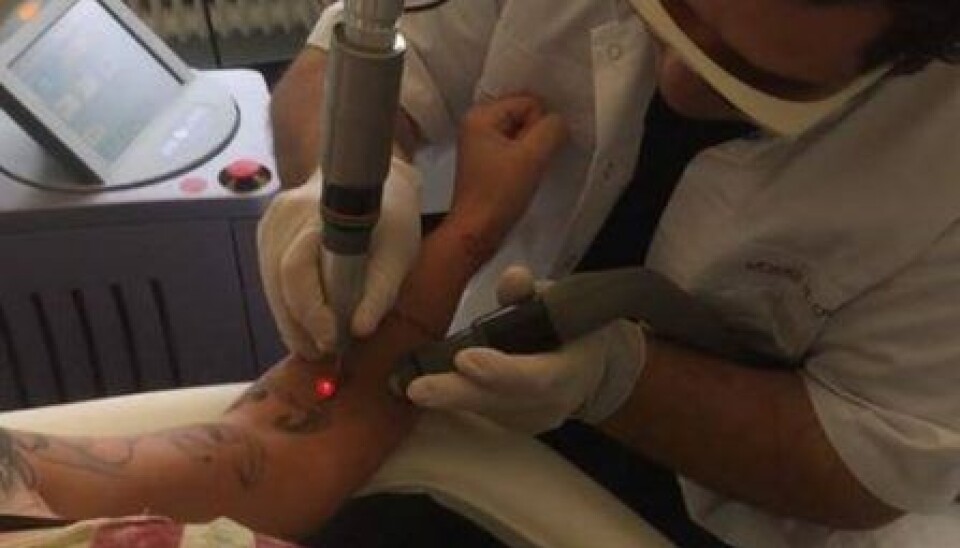 Geggo har sat sig under laseren for at få fjernet en del af sine tatoveringer. (Foto: Privat).