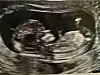 Der ligger en lille baby og hygger sig i Geggos mave. (Foto: Privat)