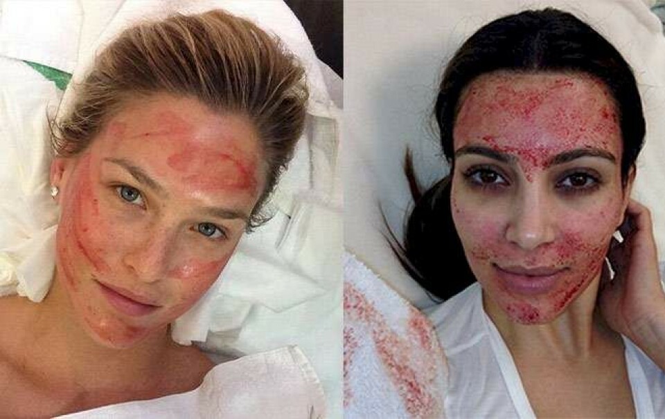 Blodigt: Her er tidens skøreste ansigtsbehandling