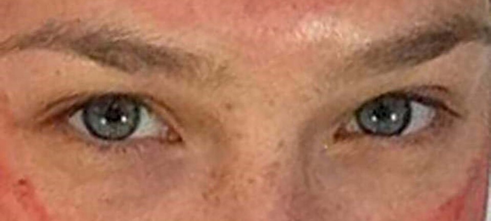 Blodigt: Her er tidens skøreste ansigtsbehandling