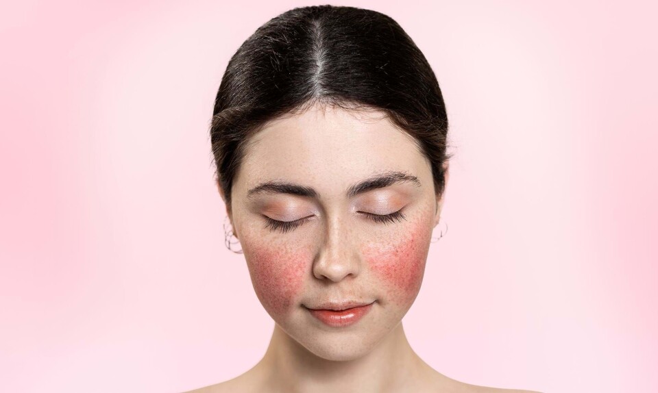 Rosacea ansigt
