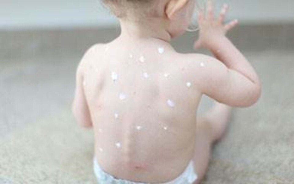 Kan man få skoldkopper to gange?