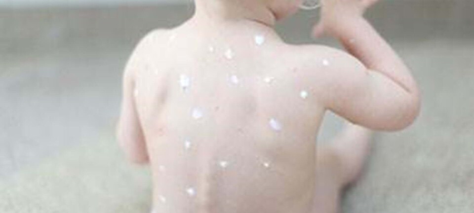 Kan man få skoldkopper to gange?