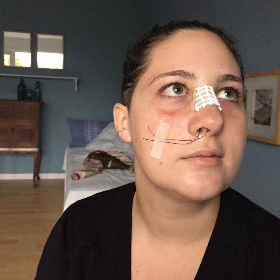 Amanda blev fejlbehandlet for sin hjernerystelse: ”Jeg skulle nok have insisteret, men der var ingen, der tjekkede mig”