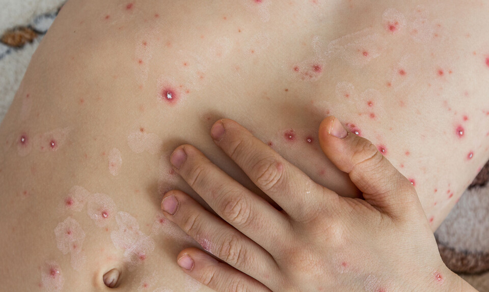 Varicella zoster virus