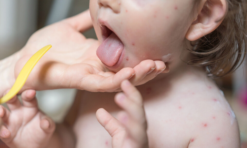 Varicella zoster virus