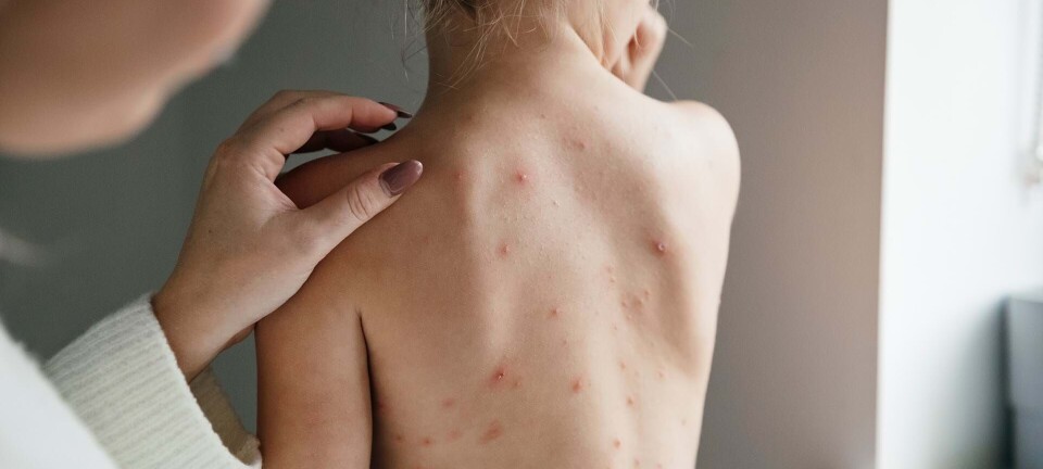 Har dit barn skoldkopper? Sådan klarer I de røde knopper