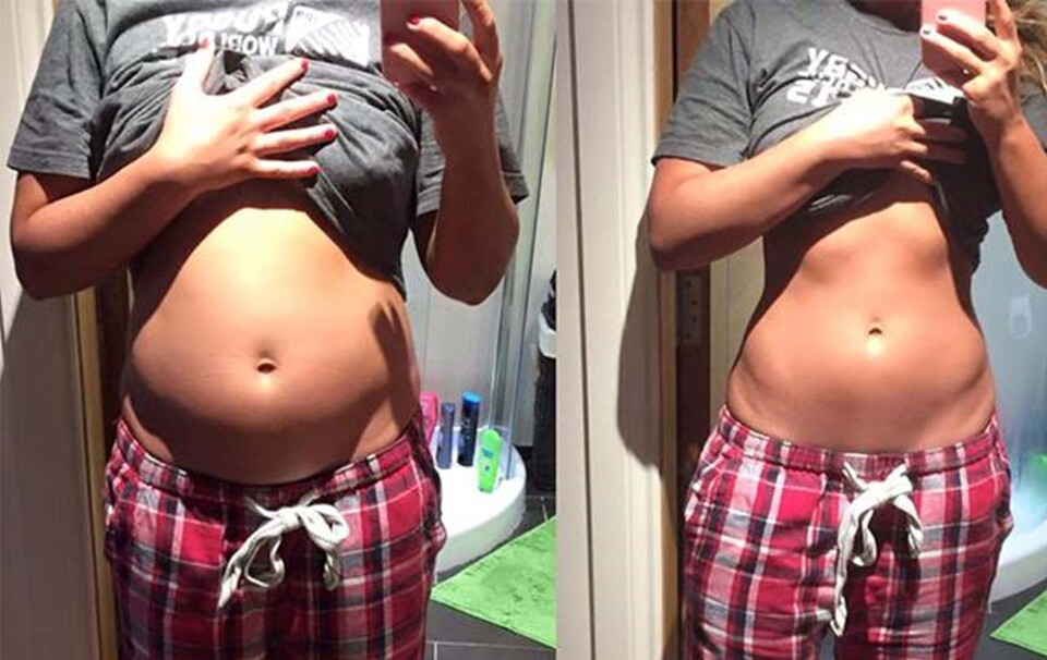 Fitness-blogger viser billede af sin oppustede mave med vigtigt budskab