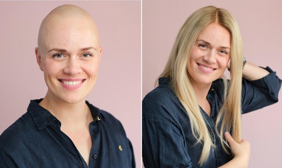 Alopecia_hanna2.jpg