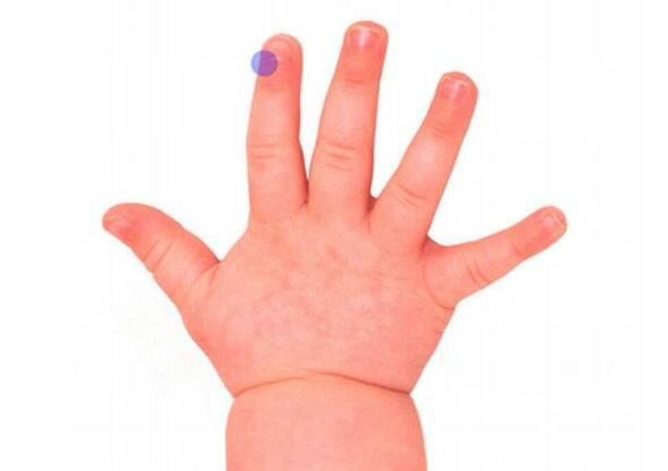 Tyktarmsknappen zoneterapi punkter