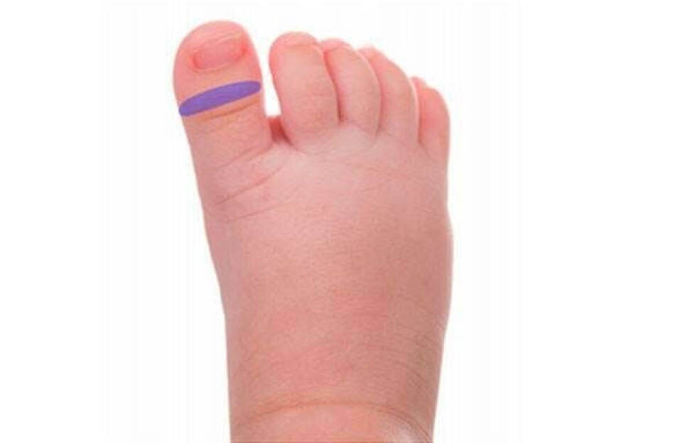 Næsezone zoneterapi punkter