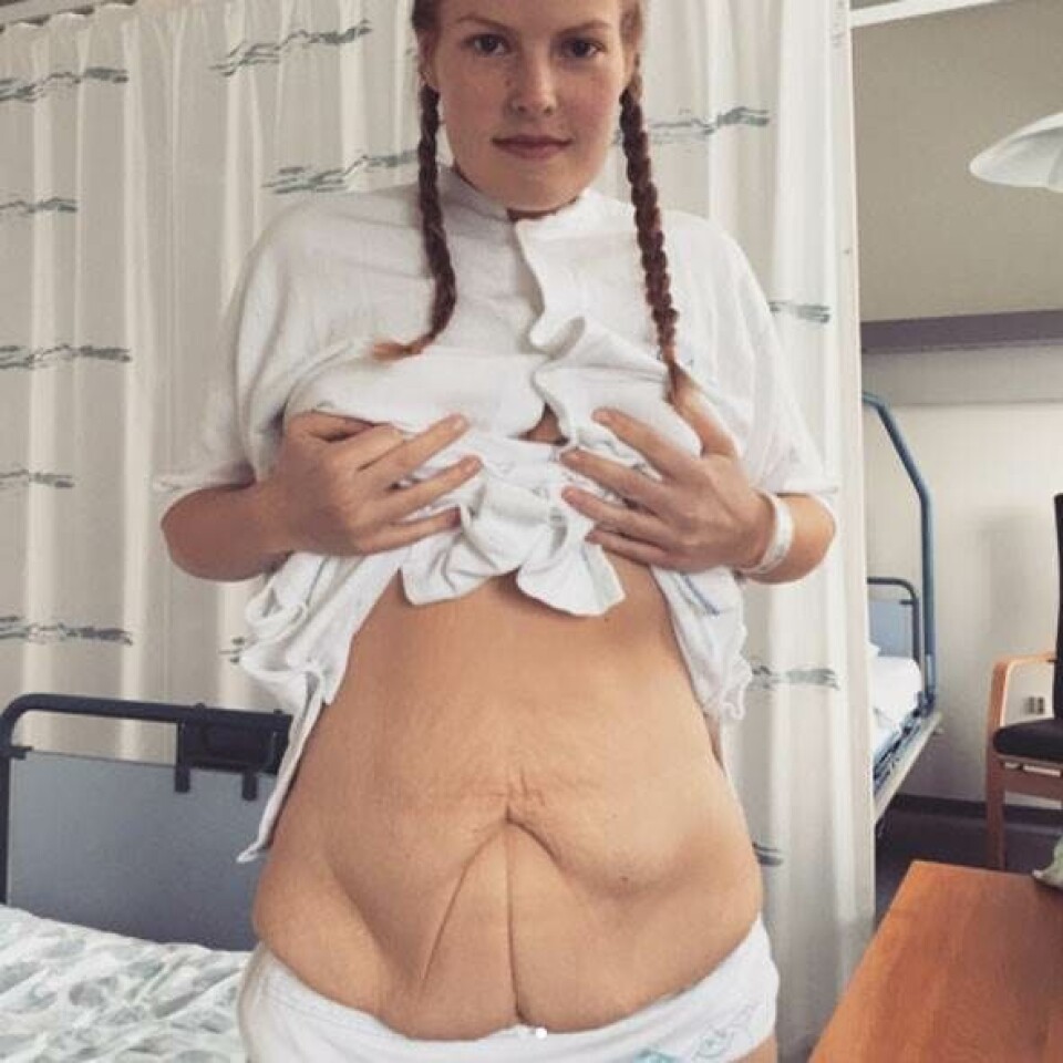Astrid tabte sig 86 kilo, men fik det sværere med sin krop under tøjet