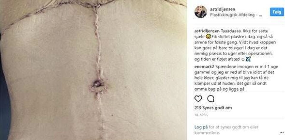 Astrid tabte sig 86 kilo, men fik det sværere med sin krop under tøjet