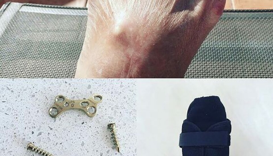 På Instagram sørgede Hilda selv for at forevige den skrue, hun havde løs– både mens den endnu sad i foden og efter operationen, hvor lægerne valgte at tage en indopereret plade ud. (Foto: Privat)
