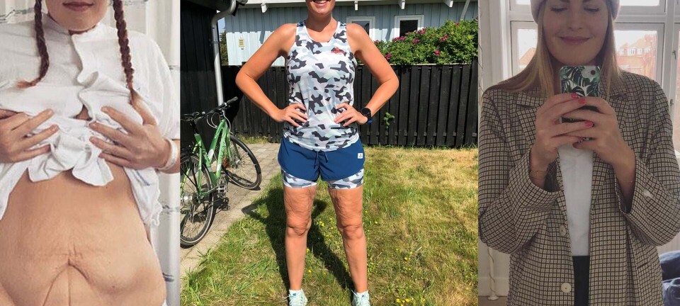 Ny podcast: Astrid tabte over 80 kilo, men så kom problemerne ...