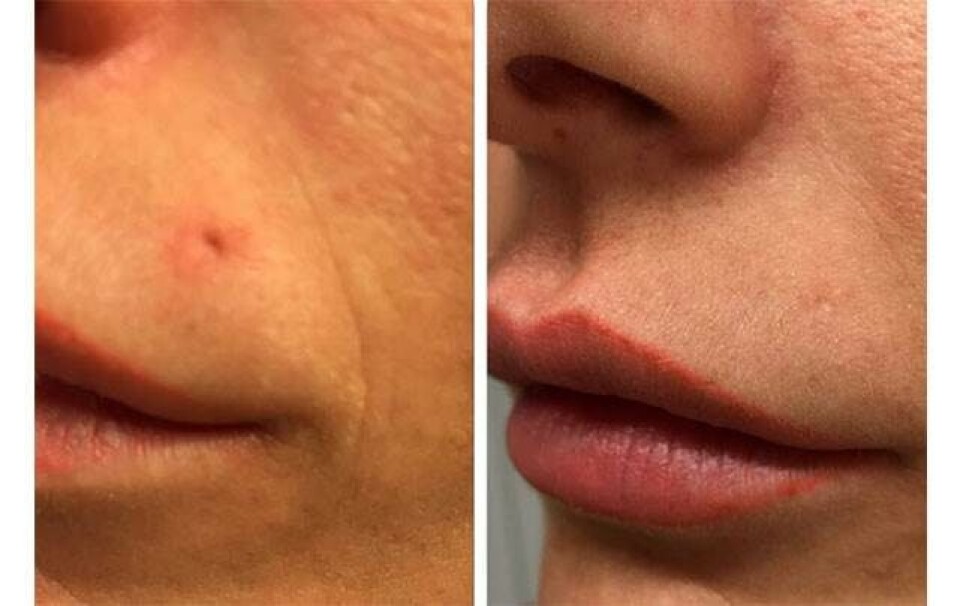 Har du også et ar efter din Madonna-piercing?