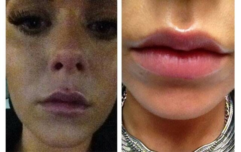 Har du også et ar efter din Madonna-piercing?