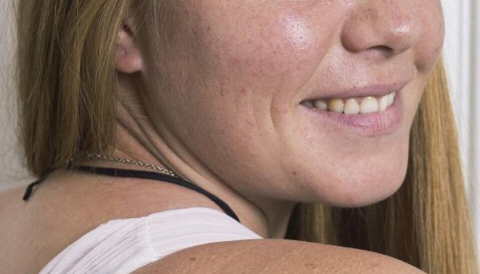 Rikke har fået tatoveret kokosnødder på skulderen.– Vi spiste kokosnødder hver dag, så det blev mit symbol på oplevelsen. (Foto: Peter Hauerbach)