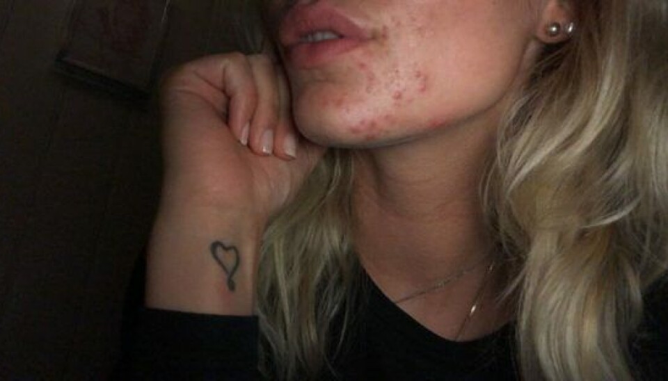 Billedet viser Frejas akne og er taget i september 2019. (Foto: Privat)