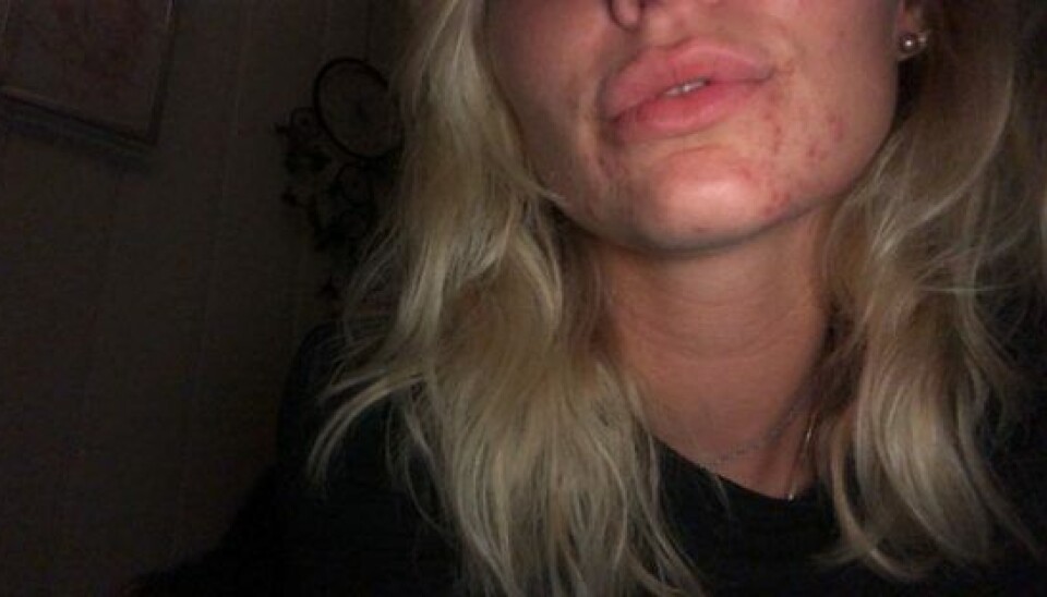 Freja, da hun stadig døjede med akne. (Foto: Privat)