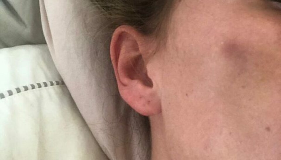 Julie Melsen havde blå mærker to uger efter sin full face make over (Foto: Privat)