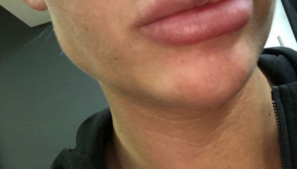 Massiv kritik af klinikken, der laver nye ansigter til realitystjernerne