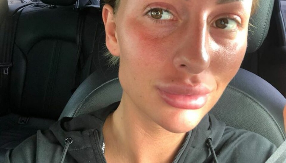 Julie er meget utilfreds med sin behandling, hvor hun har en ubehagelig klump botox siddende i kæben på højre side (Foto: Privat)