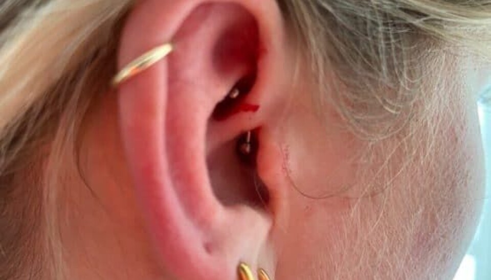 Emilies helt friske Daith-piercing (Foto: Privat)