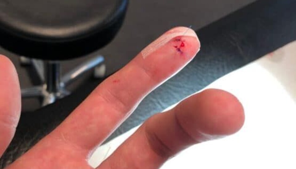 Emil skar sig i fingeren i aftenens afsnit af 'Den store bagedyst' (Foto: privat)