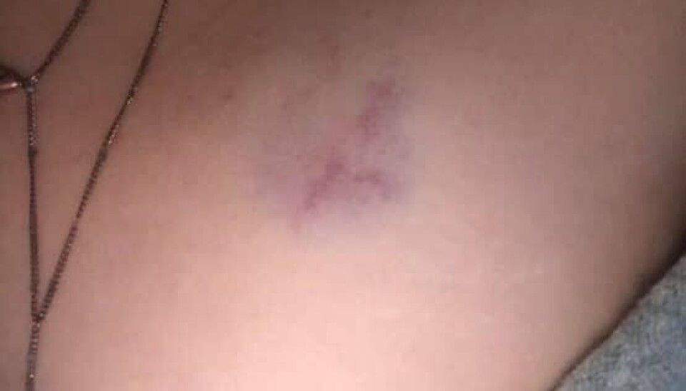 Sandra har blå mærker efter ekskærestens voldelige adfærd (Foto: privat)