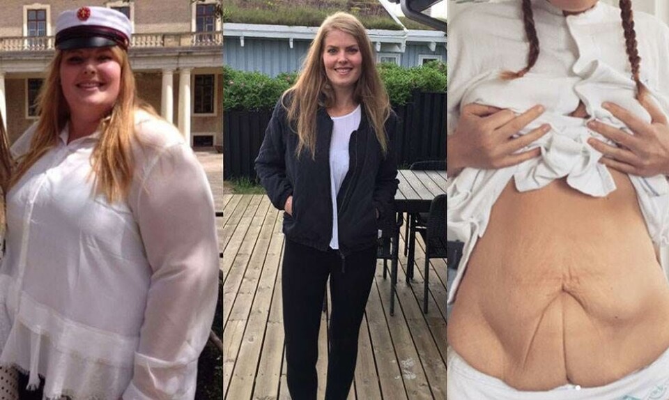 vægttab og hudreduktion