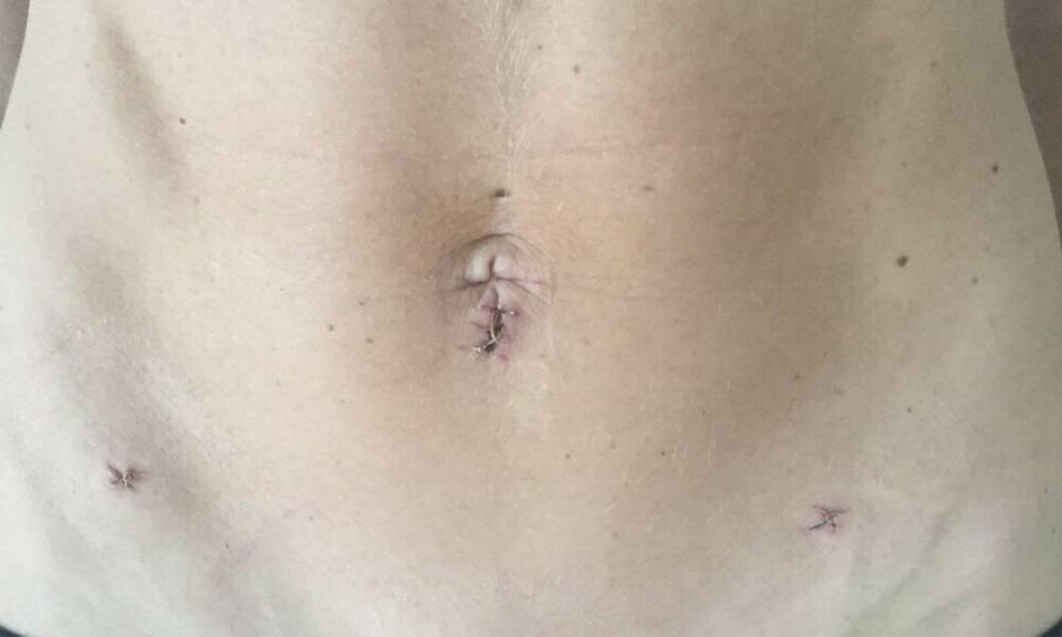 Gravid uden for livmoderen