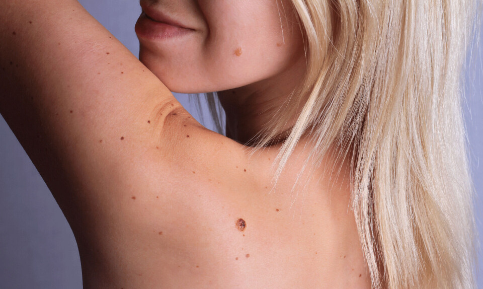 Modermærkekræft: Sådan tjekker du dine modermærker