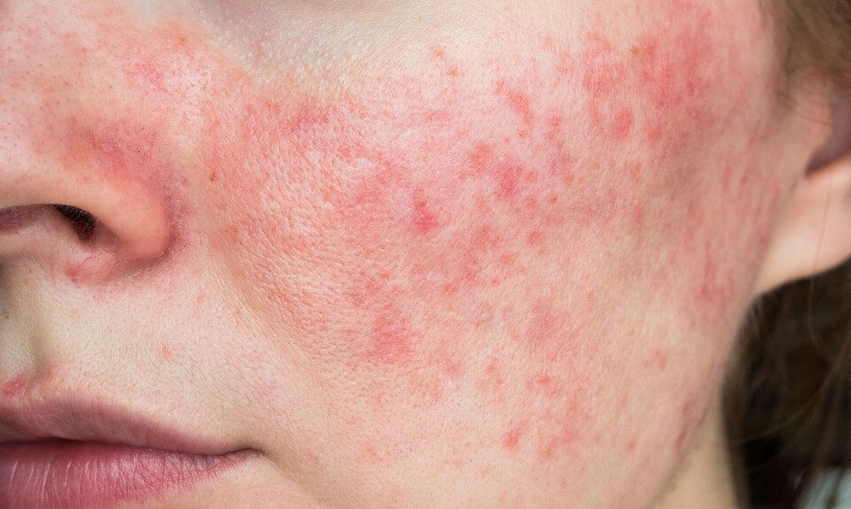 Bedste produkter mod rosacea