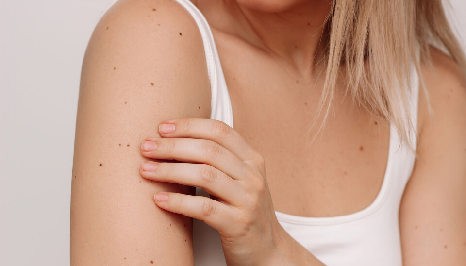 Sådan skelner du mellem farlige og ufarlige pletter på din hud