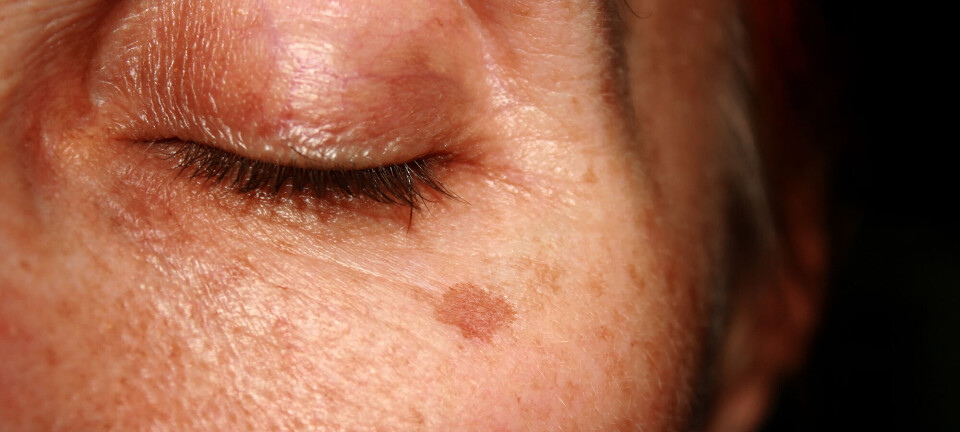 Her er to metoder, som hjælper mod pigmentpletter, ifølge hudlægen