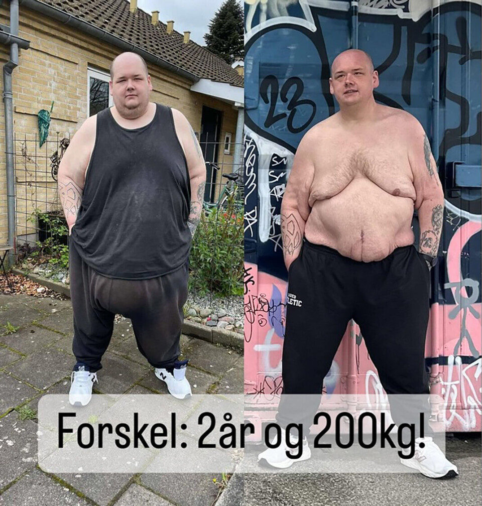 På sin populære Instagram har han vist maven frem efter operationen. – Det generer mig ikke. Sådan ser jeg jo ud.