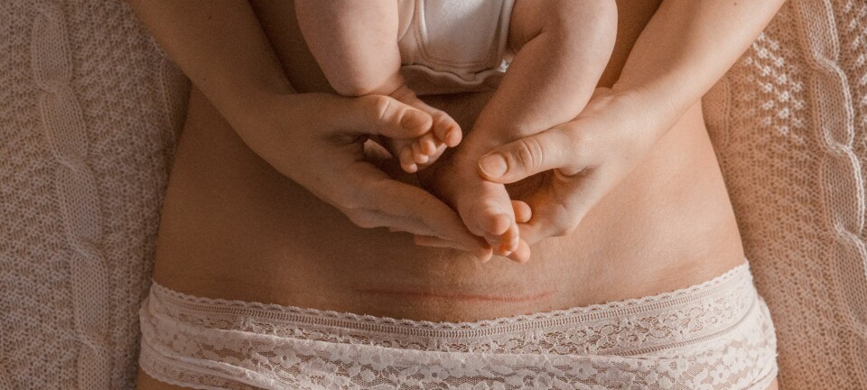 Skal du have et kejsersnit? Her er fødselslægens råd til alt, du skal vide om fødslen, fra start til slut
